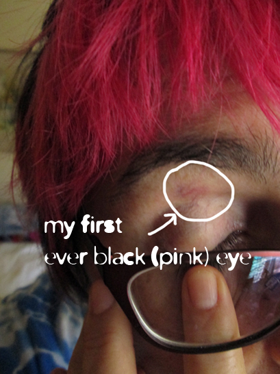 me showing my 'black' (pink) eye